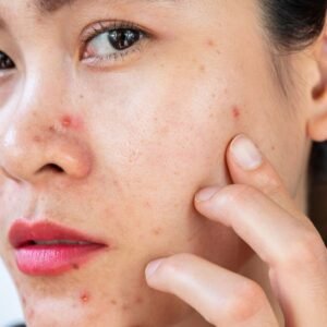 Acne Treatment