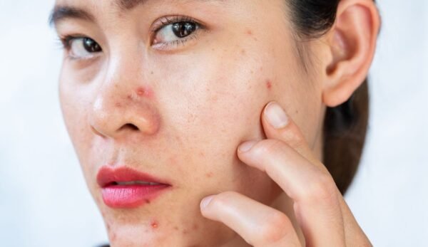 Acne Treatment
