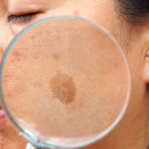 Spot Treatment