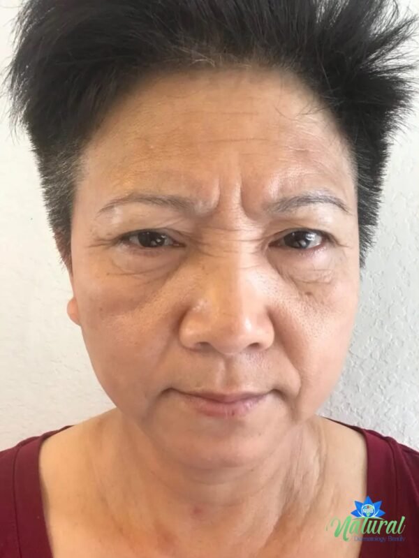 Anti Aging